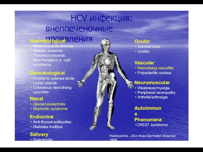 Hadziyannis. J Eur Acad Dermatol Venereol. 1998. HCV инфекция: внеппеченочные проявления Haematological