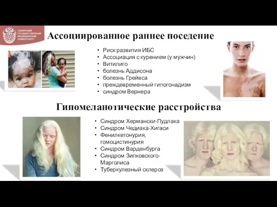 Ассоциированное раннее поседение Риск развития ИБС Ассоциация с курением (у мужчин) Витилиго