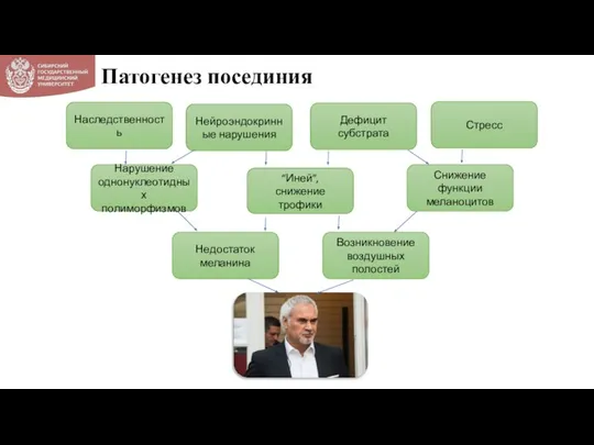 Патогенез посединия Возникновение воздушных полостей Недостаток меланина Снижение функции меланоцитов “Иней”, снижение