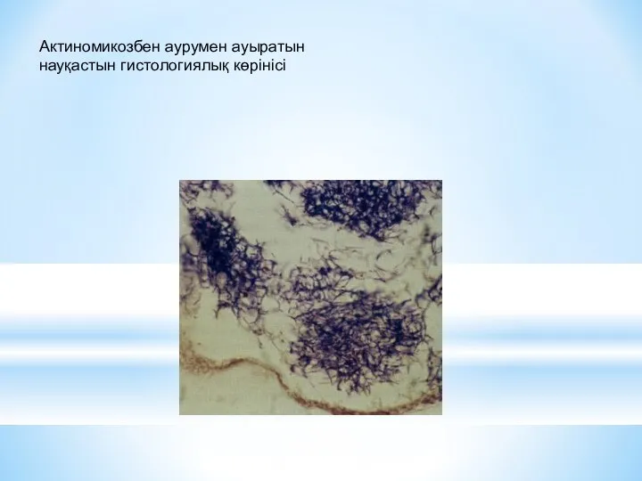 Актиномикозбен аурумен ауыратын науқастын гистологиялық көрінісі