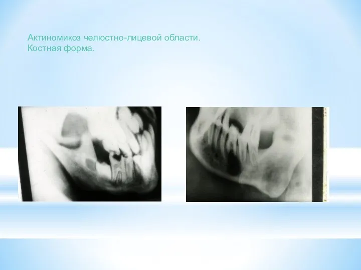 Актиномикоз челюстно-лицевой области. Костная форма.