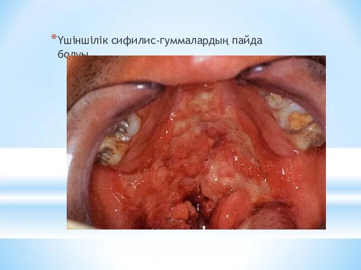 Үшіншілік сифилис-гуммалардың пайда болуы