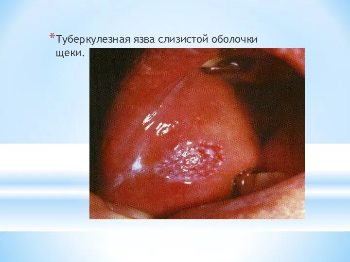 Туберкулезная язва слизистой оболочки щеки.