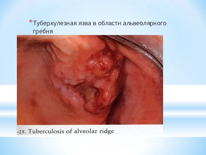 Туберкулезная язва в области альвеолярного гребня