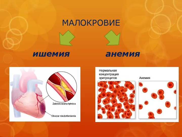 МАЛОКРОВИЕ ишемия анемия