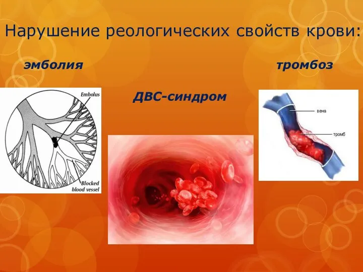 Нарушение реологических свойств крови: эмболия ДВС-синдром тромбоз
