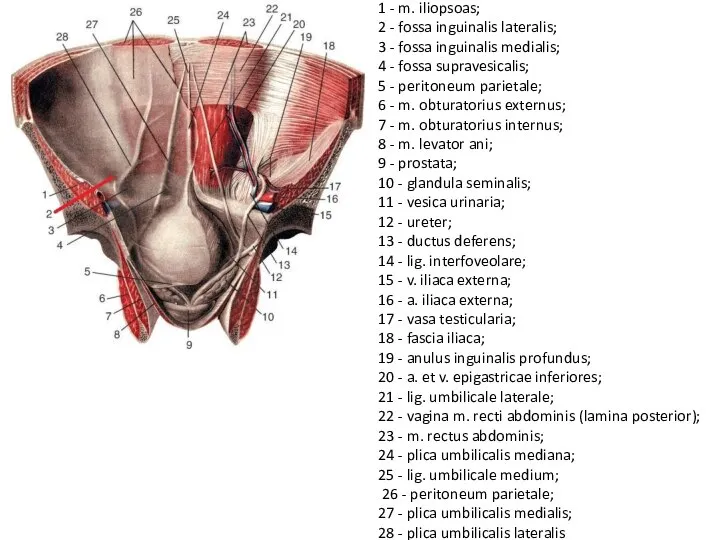 1 - m. iliopsoas; 2 - fossa inguinalis lateralis; 3 - fossa