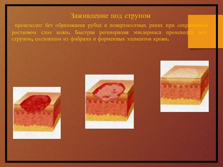 Заживление под струпом происходит без образования рубца в поверхностных ранах при сохраненном