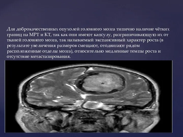 Для доброкачественных опухолей головного мозга типично наличие чётких границ на МРТ и