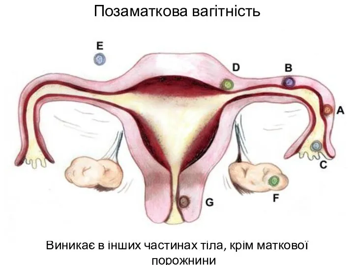 Позаматкова вагітність Виникає в інших частинах тіла, крім маткової порожнини