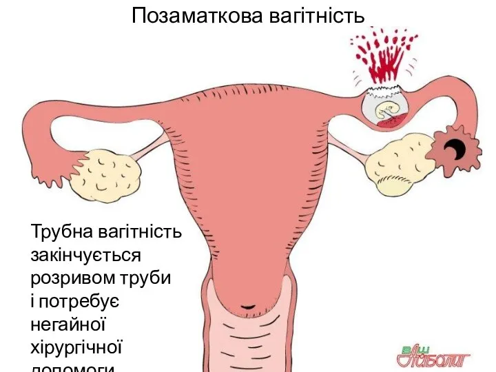 Позаматкова вагітність Трубна вагітність закінчується розривом труби і потребує негайної хірургічної допомоги