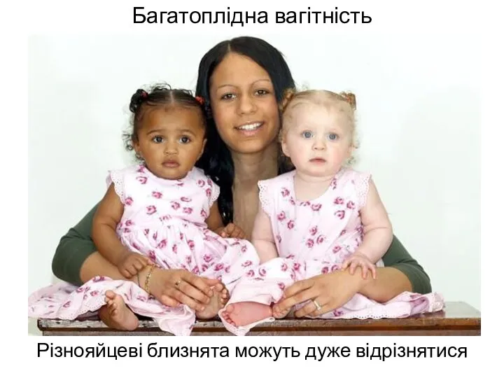 Багатоплідна вагітність Різнояйцеві близнята можуть дуже відрізнятися