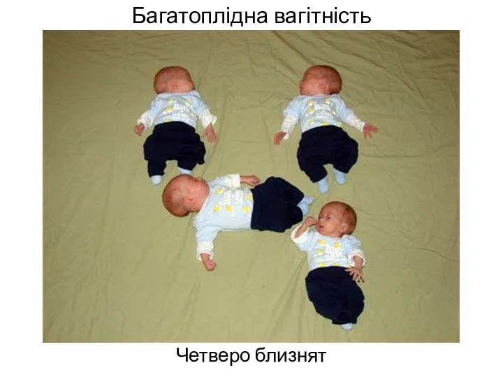 Багатоплідна вагітність Четверо близнят