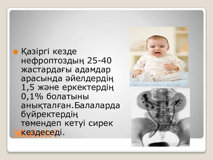 Жиілігі Қазіргі кезде нефроптоздың 25-40 жастардағы адамдар арасында әйелдердің 1,5 және еркектердің