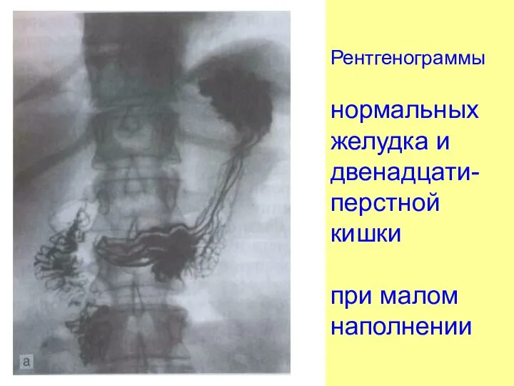 Рентгенограммы нормальных желудка и двенадцати-перстной кишки при малом наполнении