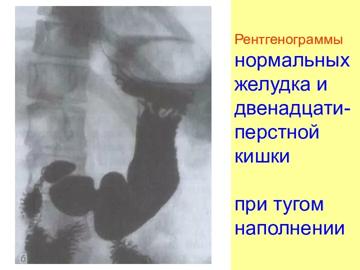 Рентгенограммы нормальных желудка и двенадцати-перстной кишки при тугом наполнении