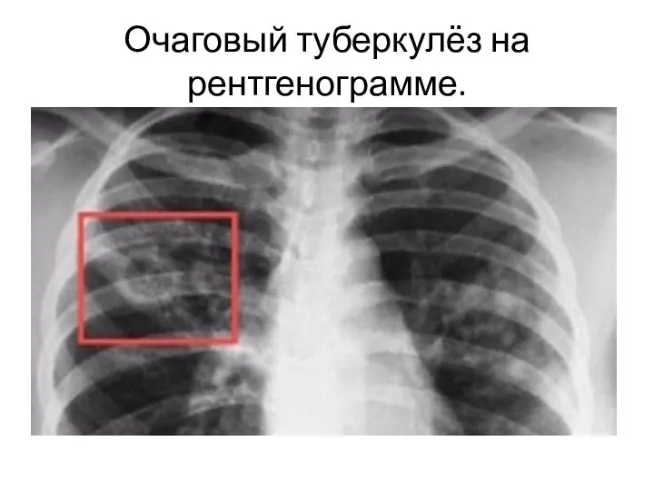 Очаговый туберкулёз на рентгенограмме.