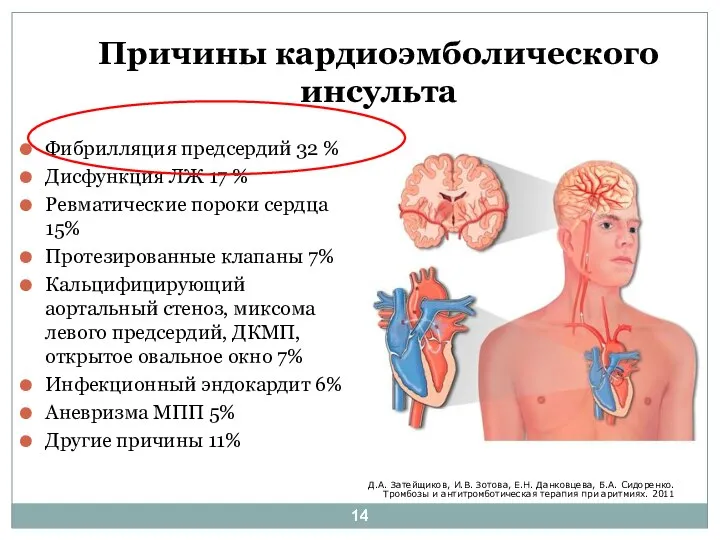 Причины кардиоэмболического инсульта Фибрилляция предсердий 32 % Дисфункция ЛЖ 17 % Ревматические