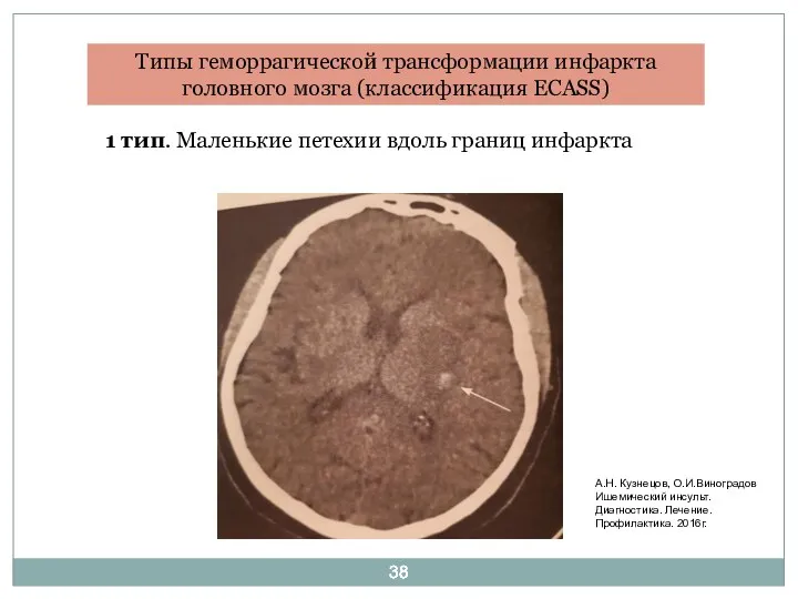 Типы геморрагической трансформации инфаркта головного мозга (классификация ECASS) 1 тип. Маленькие петехии