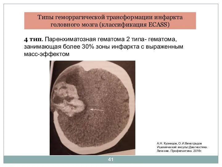 Типы геморрагической трансформации инфаркта головного мозга (классификация ECASS) А.Н. Кузнецов, О.И.Виноградов Ишемический
