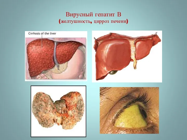 Вирусный гепатит В (желтушность, цирроз печени)