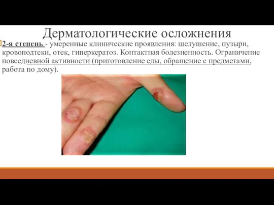 2-я степень - умеренные клинические проявления: шелушение, пузыри, кровоподтеки, отек, гиперкератоз. Контактная