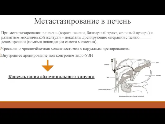 Метастазирование в печень При метастазировании в печень (ворота печени, билиарный тракт, желчный