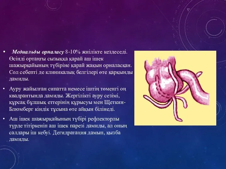 Медиальды орналасу 8-10% жиілікте кездеседі. Өсінді ортаңғы сызыққа қарай аш ішек шажырқайының