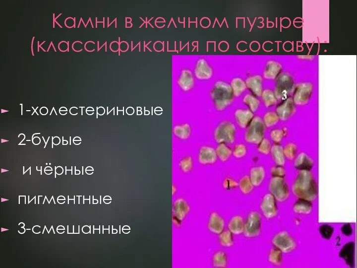 Камни в желчном пузыре (классификация по составу): 1-холестериновые 2-бурые и чёрные пигментные 3-смешанные