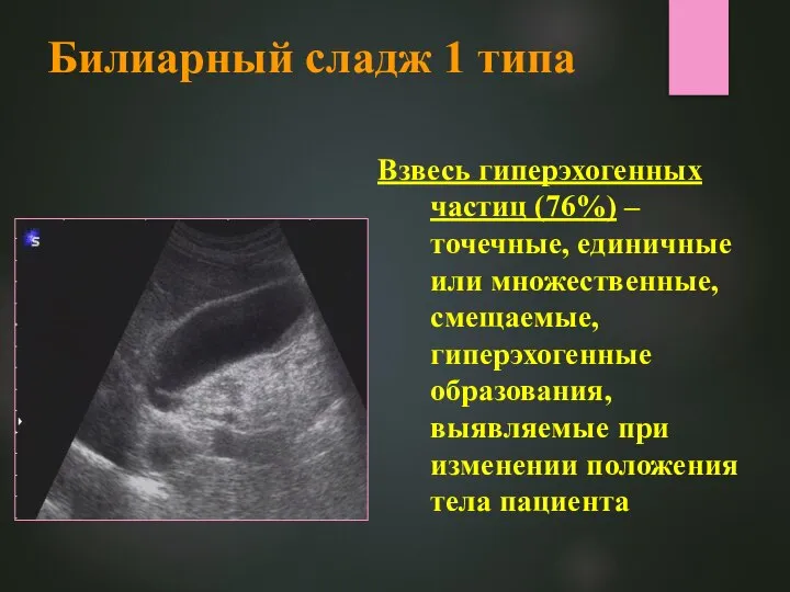 Билиарный сладж 1 типа Взвесь гиперэхогенных частиц (76%) – точечные, единичные или