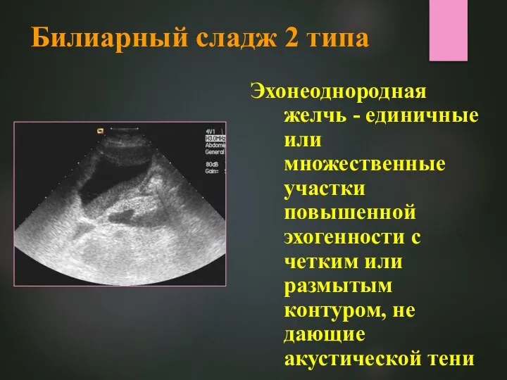 Билиарный сладж 2 типа Эхонеоднородная желчь - единичные или множественные участки повышенной