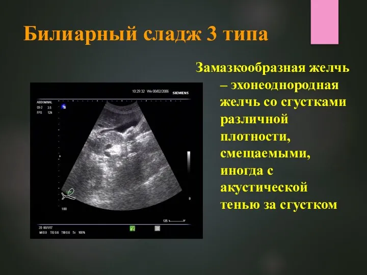 Билиарный сладж 3 типа Замазкообразная желчь – эхонеоднородная желчь со сгустками различной