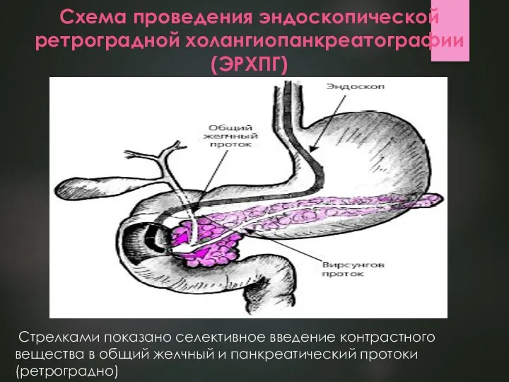 Стрелками показано селективное введение контрастного вещества в общий желчный и панкреатический протоки