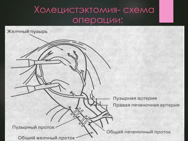 Холецистэктомия- схема операции: