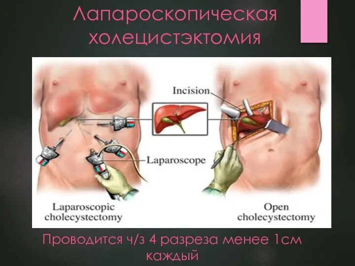 Лапароскопическая холецистэктомия Проводится ч/з 4 разреза менее 1см каждый