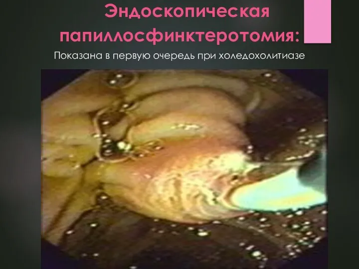 Эндоскопическая папиллосфинктеротомия: Показана в первую очередь при холедохолитиазе