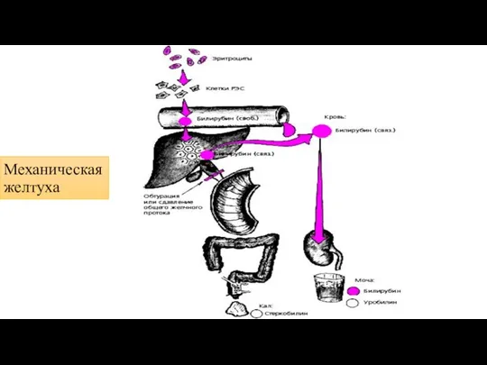 Механическая желтуха