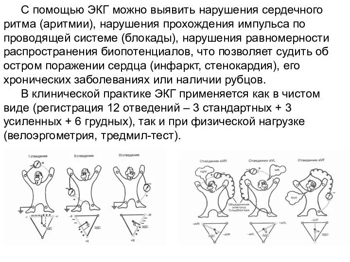 С помощью ЭКГ можно выявить нарушения сердечного ритма (аритмии), нарушения прохождения импульса