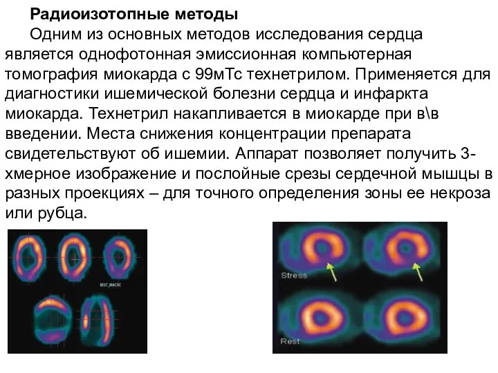 Радиоизотопные методы Одним из основных методов исследования сердца является однофотонная эмиссионная компьютерная