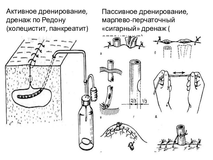 Активное дренирование, дренаж по Редону (холецистит, панкреатит) Пассивное дренирование, марлево-перчаточный «сигарный» дренаж ( аппендицит)