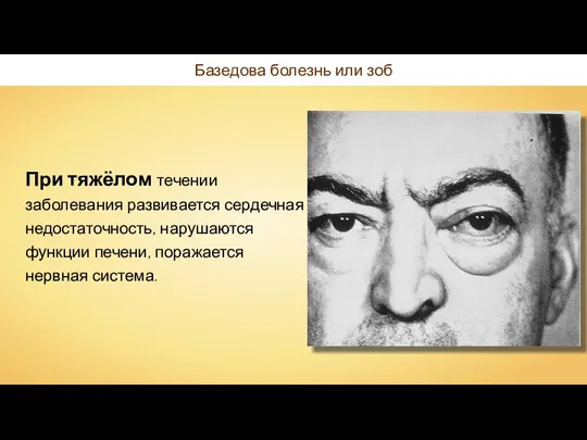 Базедова болезнь или зоб При тяжёлом течении заболевания развивается сердечная недостаточность, нарушаются