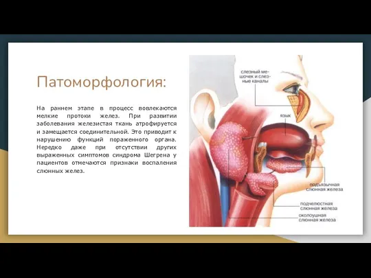 Патоморфология: На раннем этапе в процесс вовлекаются мелкие протоки желез. При развитии