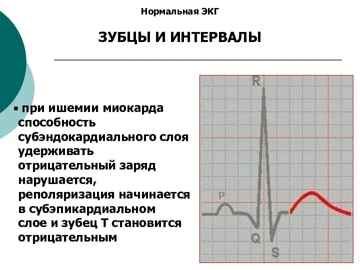 Нормальная ЭКГ ЗУБЦЫ И ИНТЕРВАЛЫ при ишемии миокарда способность субэндокардиального слоя удерживать