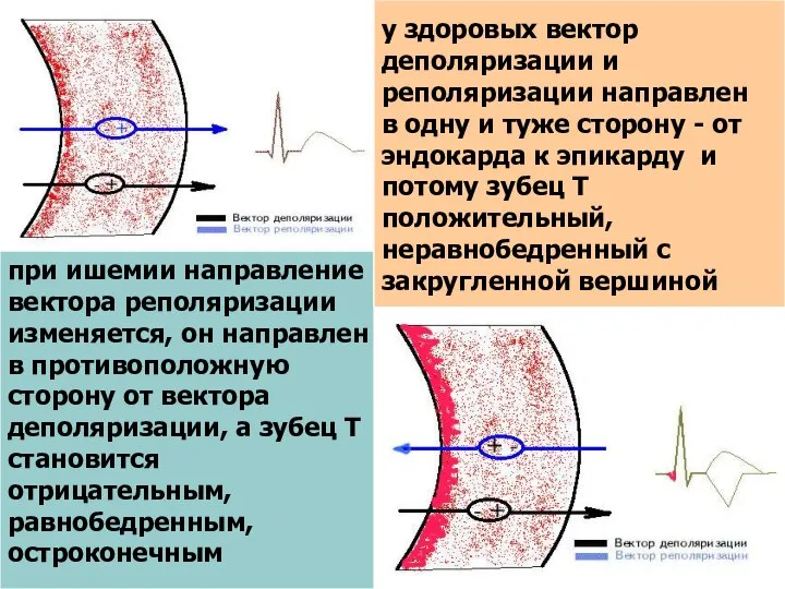 у здоровых вектор деполяризации и реполяризации направлен в одну и туже сторону