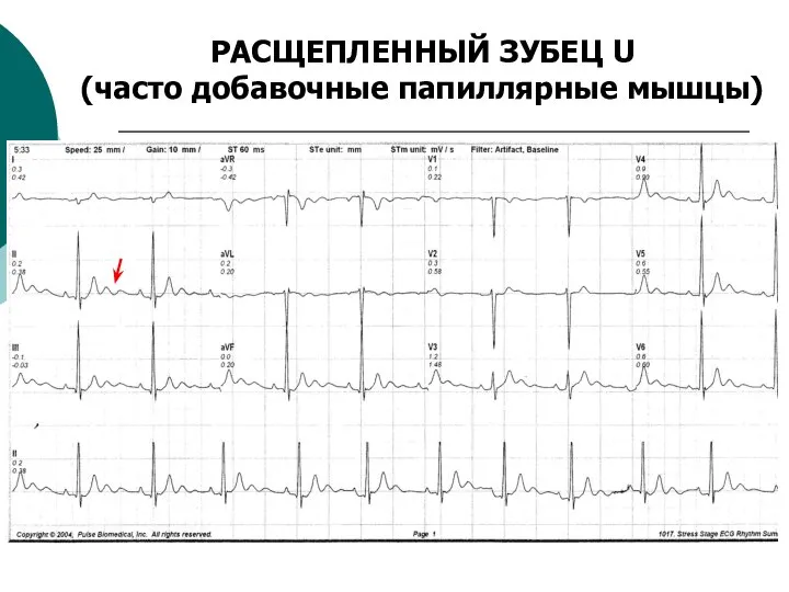 РАСЩЕПЛЕННЫЙ ЗУБЕЦ U (часто добавочные папиллярные мышцы)