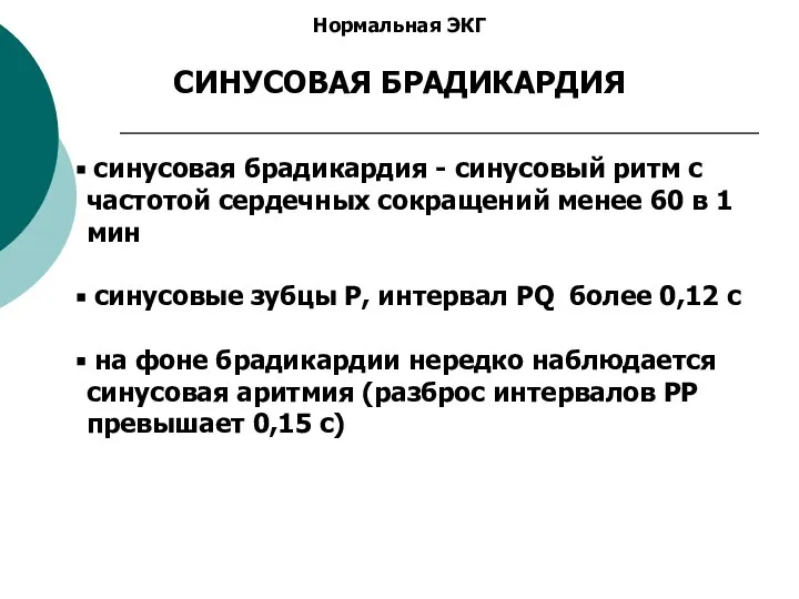 Нормальная ЭКГ СИНУСОВАЯ БРАДИКАРДИЯ синусовая брадикардия - синусовый ритм с частотой сердечных