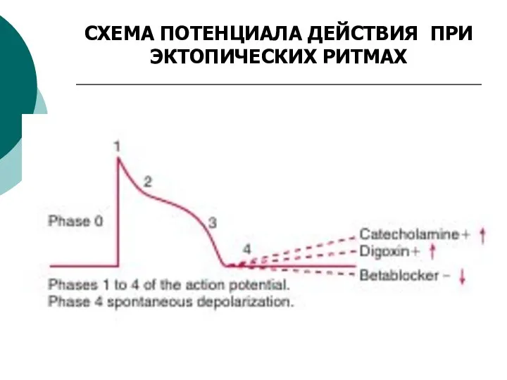 СХЕМА ПОТЕНЦИАЛА ДЕЙСТВИЯ ПРИ ЭКТОПИЧЕСКИХ РИТМАХ