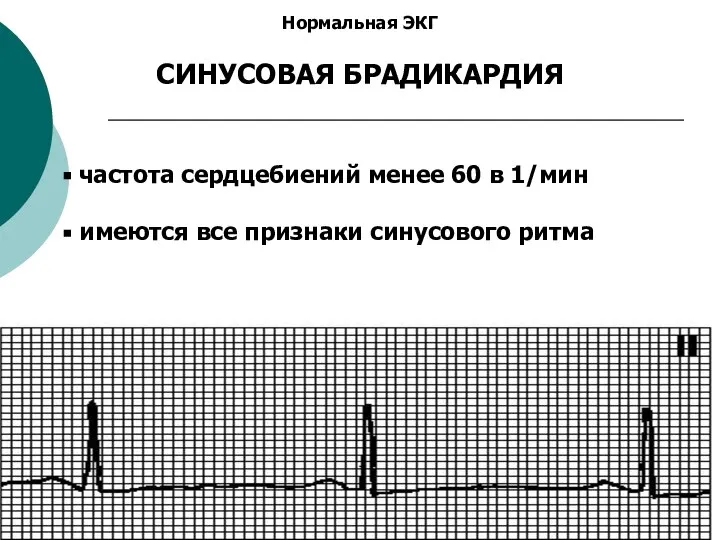 Нормальная ЭКГ СИНУСОВАЯ БРАДИКАРДИЯ частота сердцебиений менее 60 в 1/мин имеются все признаки синусового ритма