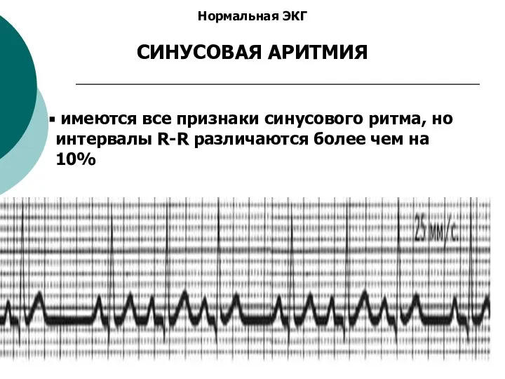 Нормальная ЭКГ СИНУСОВАЯ АРИТМИЯ имеются все признаки синусового ритма, но интервалы R-R