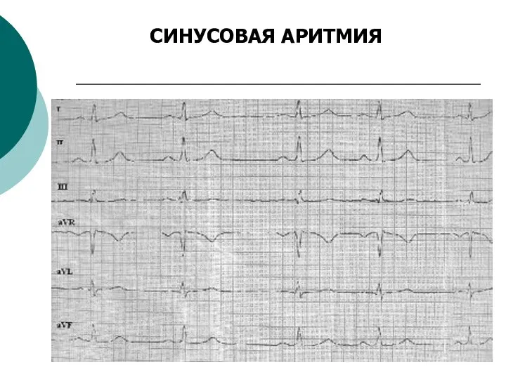 СИНУСОВАЯ АРИТМИЯ